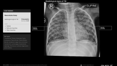 Paediatric chest X-ray scan analysis Paediatric chest X-ray scan analysis