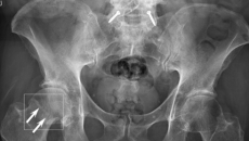 An image of the software detecting a fracture near a patient's hip