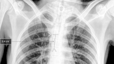 A chest x-ray showing Qure.ai's technology for breathing tube placement A chest x-ray showing Qure.ai's technology for breathing tube placement
