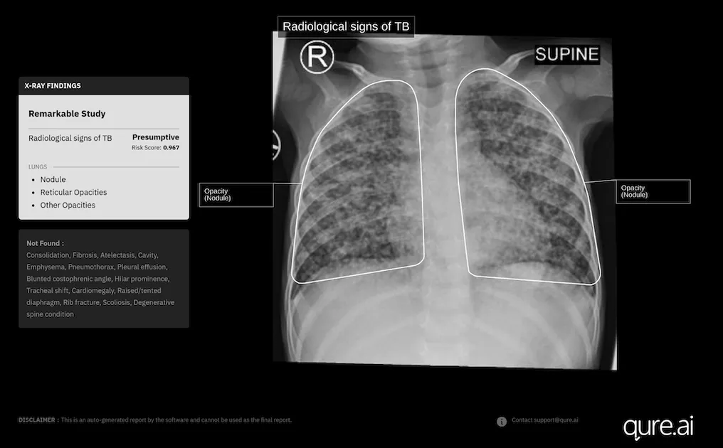 Paediatric chest X-ray scan analysis Paediatric chest X-ray scan analysis