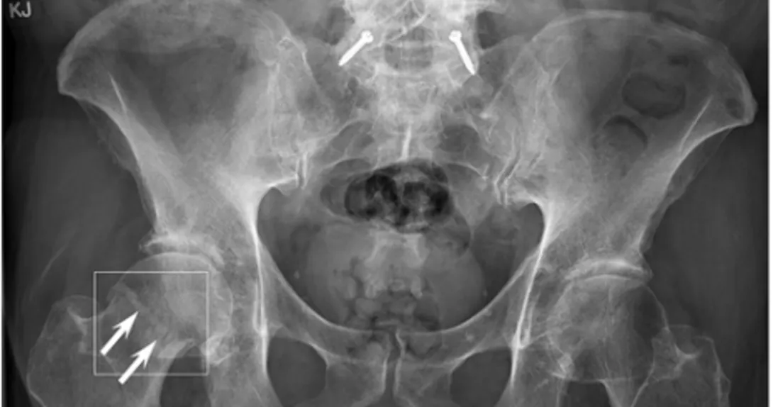 An image of the software detecting a fracture near a patient's hip An image of the software detecting a fracture near a patient's hip