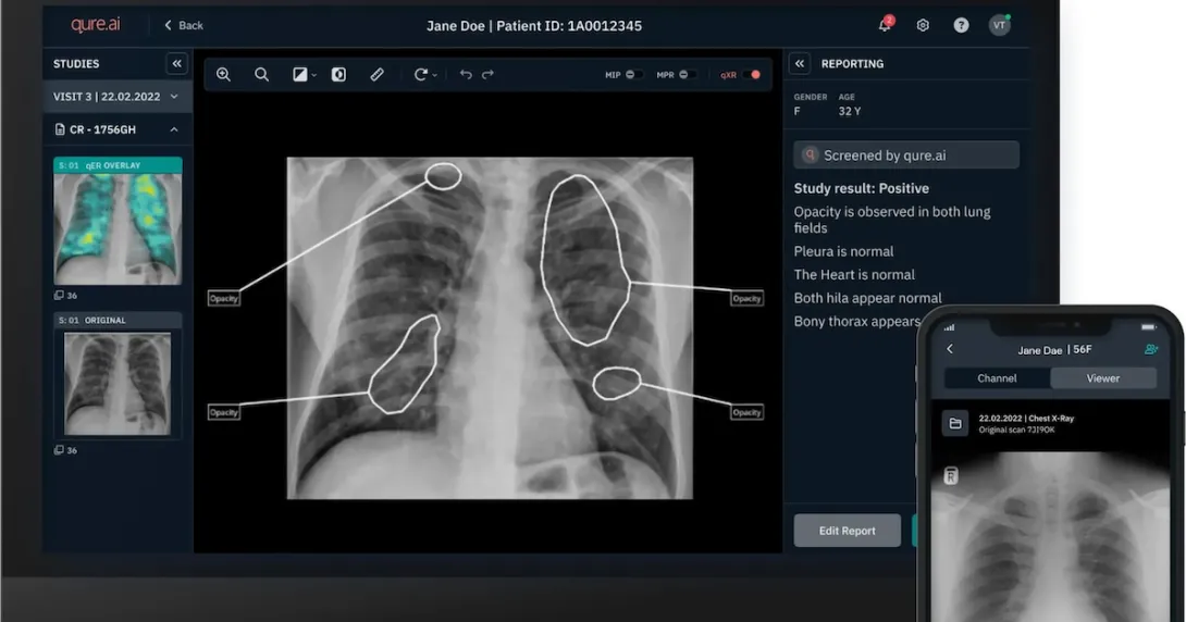 Mobile and desktop versions of Qure.ai's chest X-ray analysis solution Mobile and desktop versions of Qure.ai's chest X-ray analysis solution