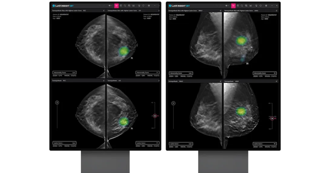 An analysis report generated by the Lunit INSIGHT DBT An analysis report generated by the Lunit INSIGHT DBT