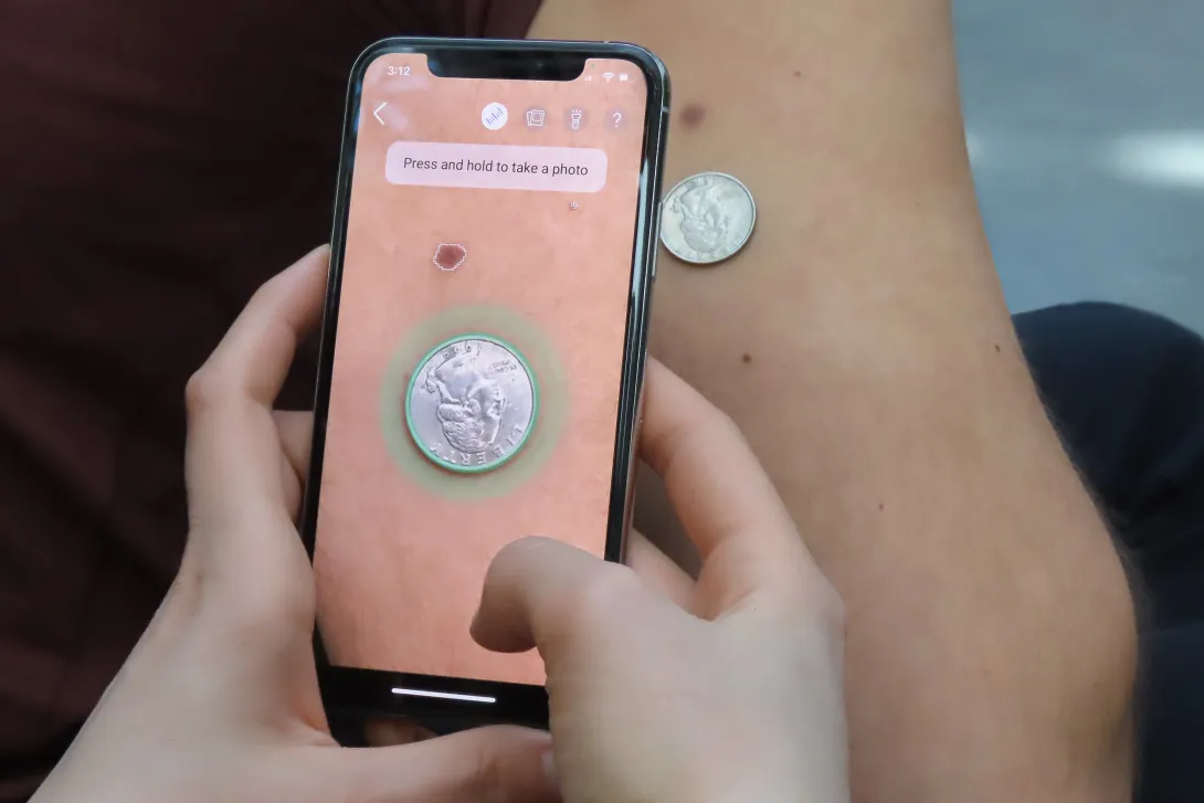 The Danish consumer platform helps users track skin changes. Miiskin, skin cancer
