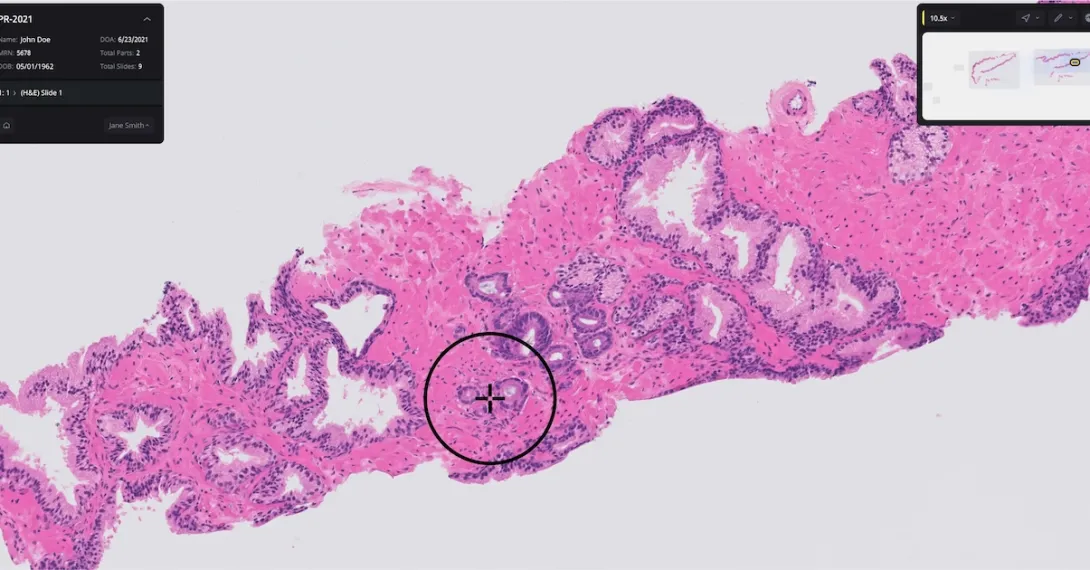 Paige Prostate software identifying a suspicious area in a biopsy slide