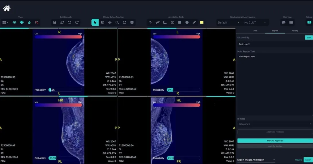 An interface of FxMammo, the AI breast cancer screening support solution by FathomX