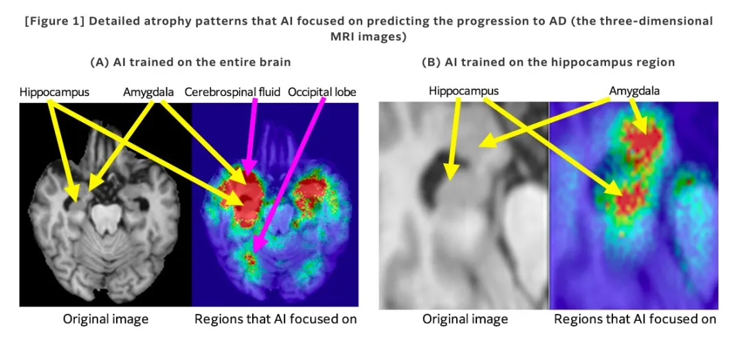 Detailed atrophy patterns that AI focused on predicting the progression to Alzheimer's disease