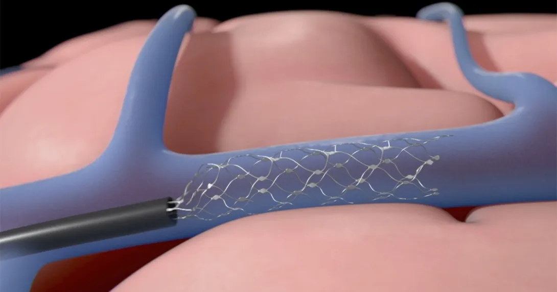 Animated image of Synchron's Stentrode device getting implanted into the brain