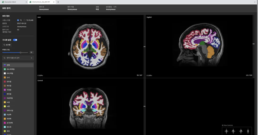 Neurophet's brain MRI scan analysis AI software shown on a desktop monitor Neurophet's brain MRI scan analysis AI software shown on a desktop monitor