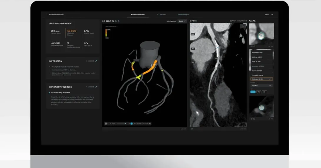 Salix Coronary Anatomy by Artrya