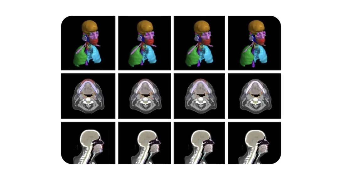 An image from the radiotherapy planning model developed by Google and the Mayo Clinic. An image from the radiotherapy planning model developed by Google and the Mayo Clinic.